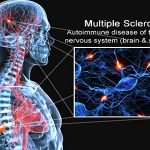 Multiple Sclerosis